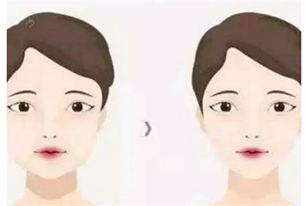 面部吸脂，大脸变v脸，但这些副作用如何避免?