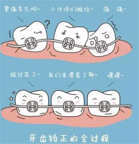 成人矫正牙齿要多久？分享牙齿矫正方式和大约的时间轴