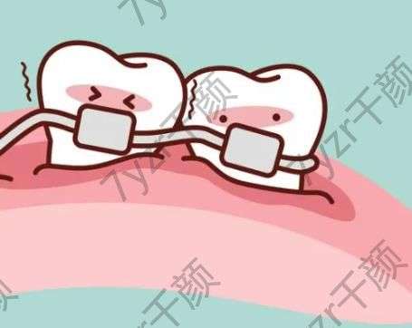 牙齿矫正器的优点和缺点是什么?