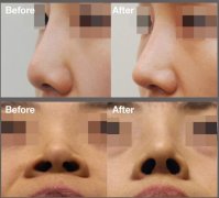 隆鼻材料——硅胶VS膨体
