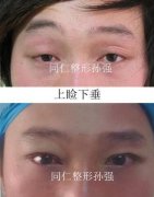 北京同仁孙强割双眼皮怎么样，有案例图吗？