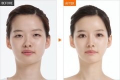 杭州艺星做韩式改脸型怎么样，有案例图吗？