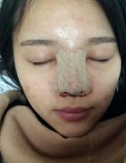 在北京做的鼻部手术手术案例，分享给大家。