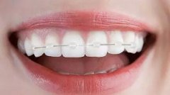 成人做牙齿正畸要多少钱？