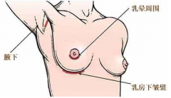 隆乳术有哪些手术方法呢？