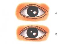 干货：眼部美学和相关的解剖构造