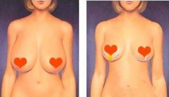 乳房下垂有哪些类型呢？