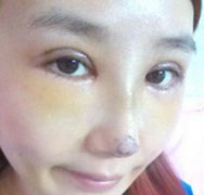 在北京莫琳娜医疗美容诊所做的隆鼻和双眼皮