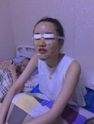 在北京做的眼部手术+鼻部手术案例