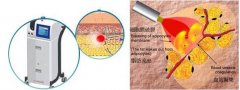 激光溶脂是如何进行的？原理是什么？