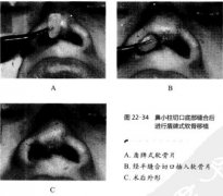 鼻部整形时，软骨片插入和固定方法是什么呢