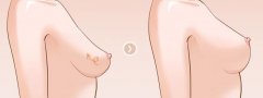 女人们的困惑，乳房下垂怎么办？