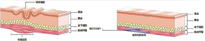 怎样祛鱼尾纹有？别相信那些土方法啦！