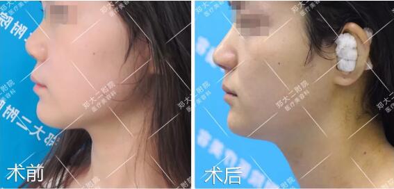 韩式耳软骨隆鼻手术案例图