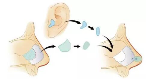 耳软骨隆鼻手术过程步骤