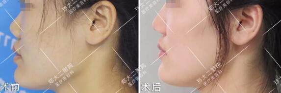 北京韩式耳软骨隆鼻手术案例图