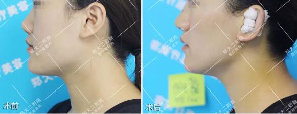 北京韩式耳软骨隆鼻手术果图