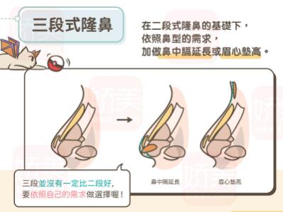 三段式假体隆鼻手术果