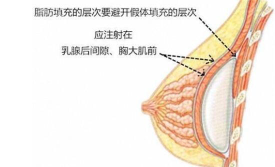 做完曼托妙桃假体隆胸后，终于拥有了S形身材！