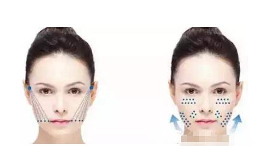 埋线除皱是什么？让你远离皱纹没烦恼！