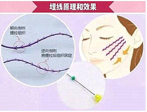 埋线除皱是什么？让你远离皱纹没烦恼！