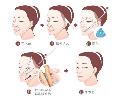 埋线除皱是什么？让你远离皱纹没烦恼！