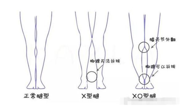 X型腿变成笔直的腿型有哪些方法？