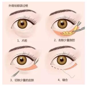 整理调节眼袋的方法几种方法！看你适合哪一种