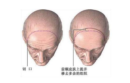 额头有皱纹，想做额部除皱手术价格是多少？