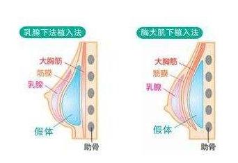 做完乳房假体植入手术之后的护理指导~