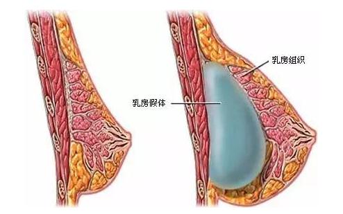 做完乳房假体植入手术之后的护理指导~