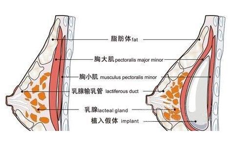 做完乳房假体植入手术之后的护理指导~