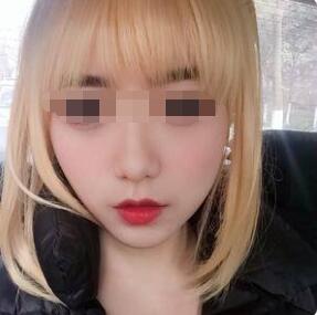 玻尿酸丰嘴唇感受~这才是丰唇正确打开方式
