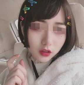 玻尿酸丰嘴唇感受~这才是丰唇正确打开方式