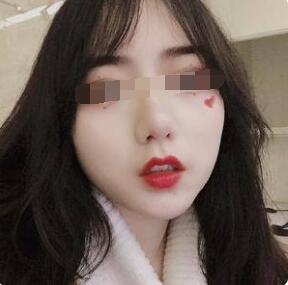玻尿酸丰嘴唇感受~这才是丰唇正确打开方式