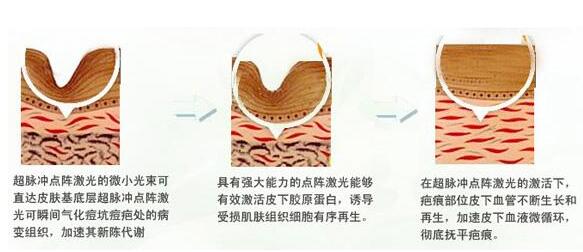 被痘印问题困扰着？激光祛痘印的果咋样？