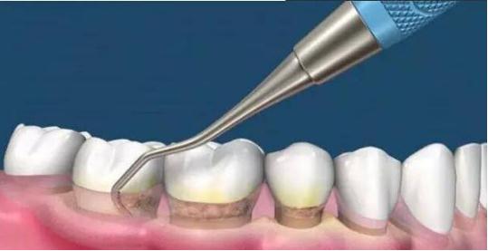 牙结石的清理方法
