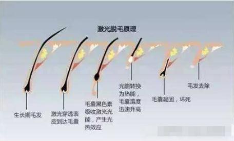 做激光脱腋毛一般需要做几次才能完全干净？