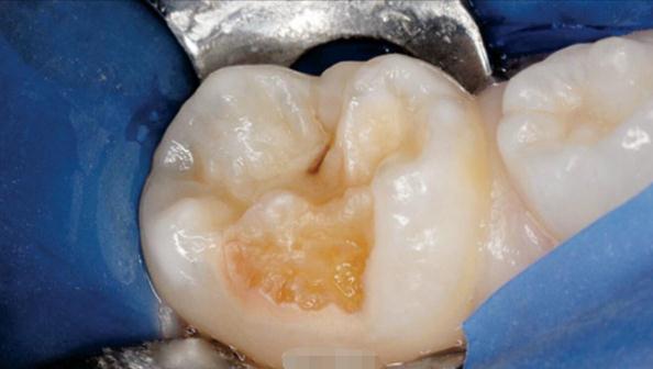 做冷光美白牙齿能解决烟民们的牙黄问题吗？