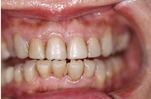 做冷光美白牙齿能解决烟民们的牙黄问题吗？
