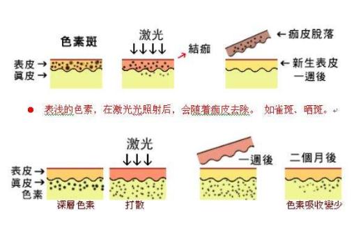 激光调节老年斑的方法简直是方便又省钱！