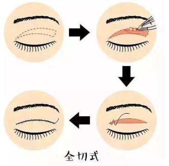 全切双眼皮拆线之后可以化妆了吗？