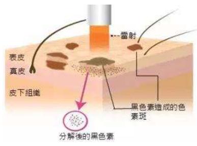 祛斑不反弹，除了激光还有什么好的办法？