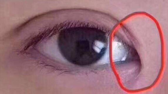 不是所有人都是适合开眼角手术！