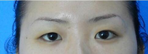 不是所有人都是适合开眼角手术！