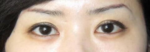 不是所有人都是适合开眼角手术！