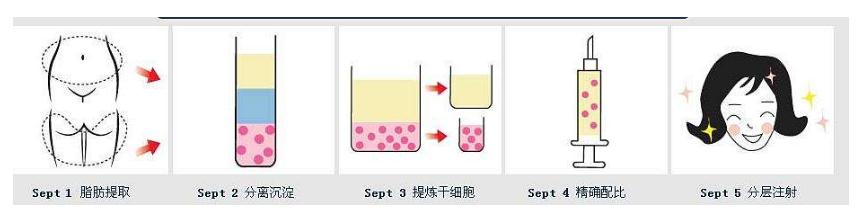 自体脂肪隆鼻的相关介绍~快来涨姿势吧！