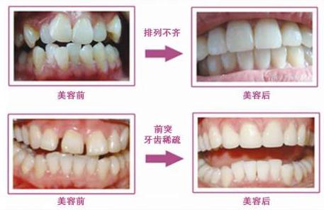 牙齿稀疏给我带来的痛这辈子忘不掉！矫正介绍