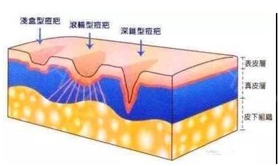 点阵激光祛痘坑展示，做几次才有？