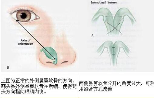 蒜头鼻做鼻尖成形术改良果好吗？美丽鼻子~